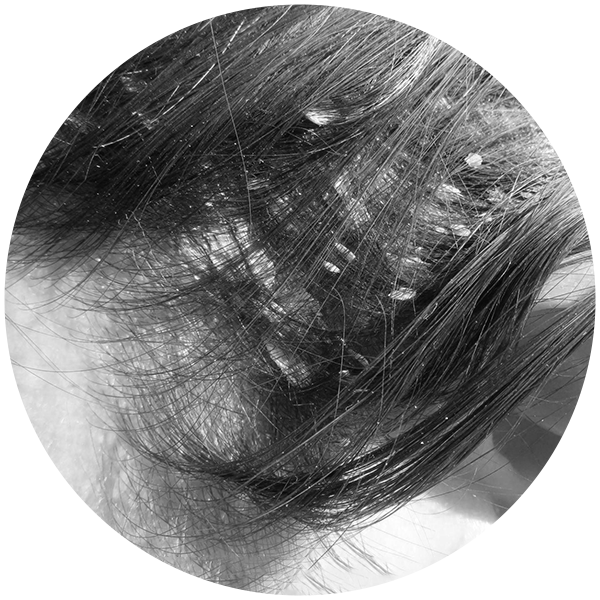 HairShield-Anti-Dandruff-Flaky-Scalp